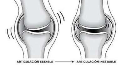 Paciente con dolor de rodilla por inestabilidad de rodilla y tratamiento conservador