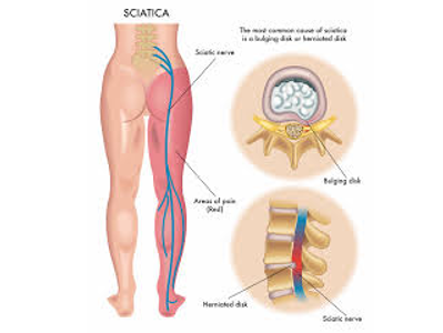 Ciática: causas, síntomas y tratamiento sin cirugía