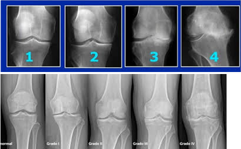 Paciente con dolor de rodilla por gonartrosis y tratamiento conservador