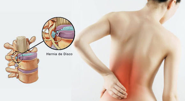 ¿Cómo saber si tu dolor de espalda puede ser una hernia de disco?