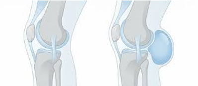 Paciente con dolor de rodilla por inflamación de la rodilla y tratamiento conservador