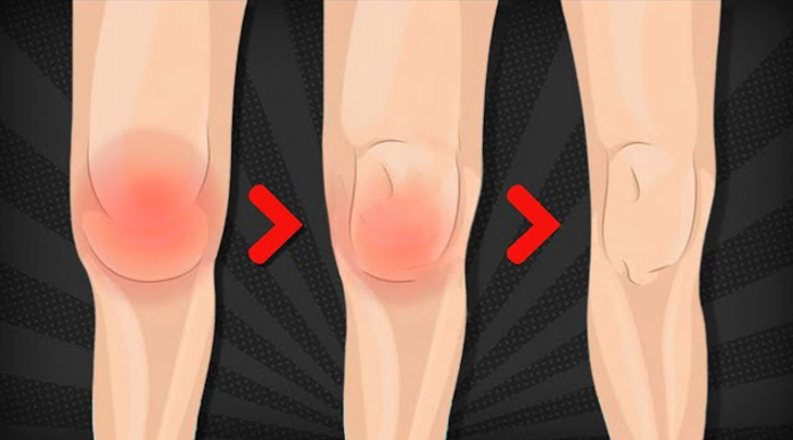 Inflamación de rodilla sin golpe previo: posibles causas