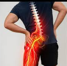 Dolor lumbar que baja a la pierna: cuándo sospechar compresión nerviosa.