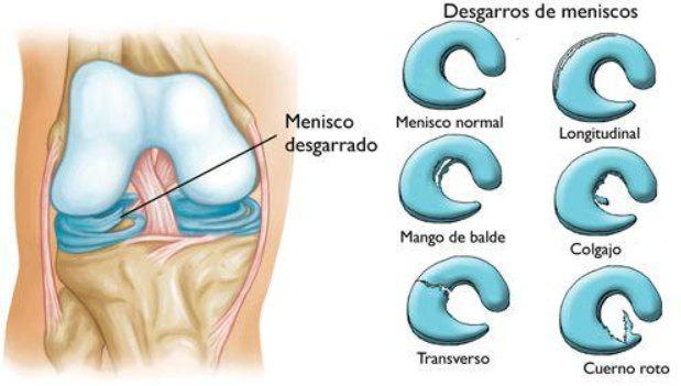 Lesiones de Meniscos: factor determinante para la salud