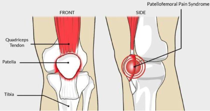 Síndrome Patelofemoral: puede afectar significativamente la calidad de vida