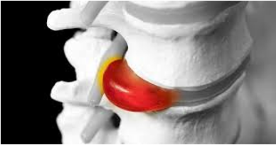 Protrusión discal: qué es y cuándo puede tratarse sin cirugía.