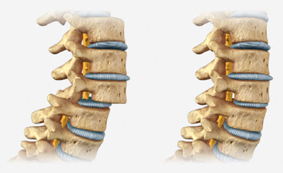 Espondilolistesis Degenerativa: patología de la columna lumbar.